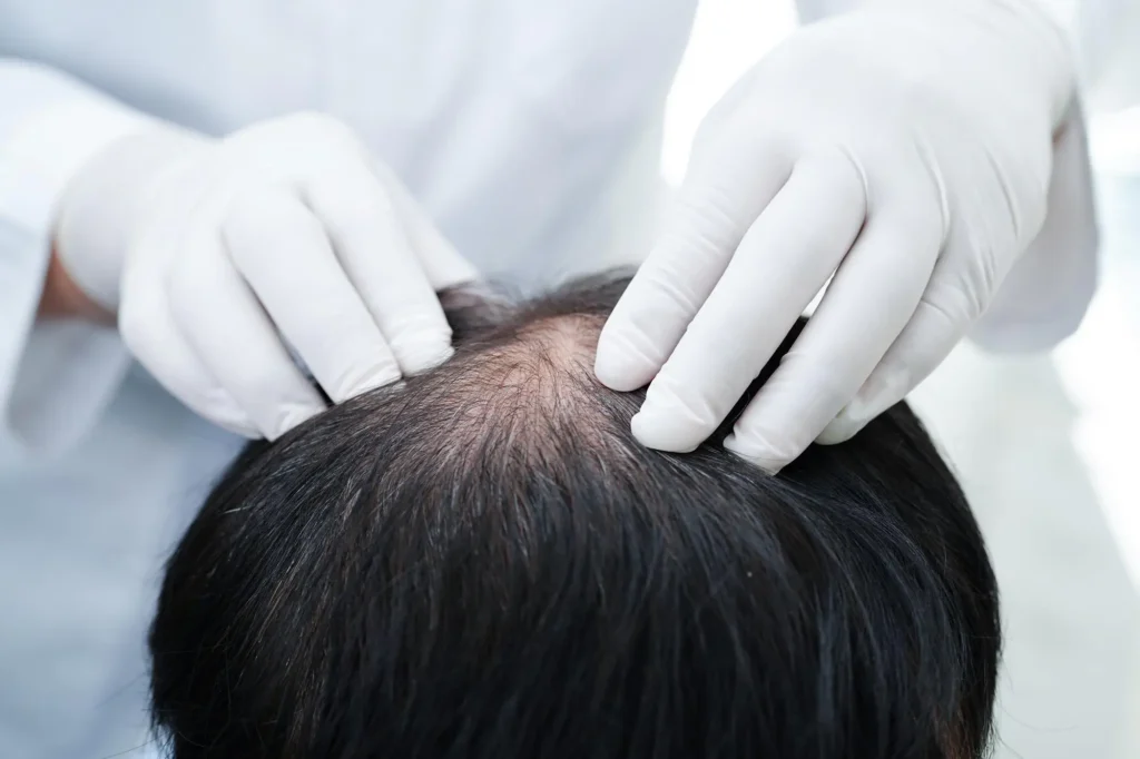 Hair Restoration 1024x682